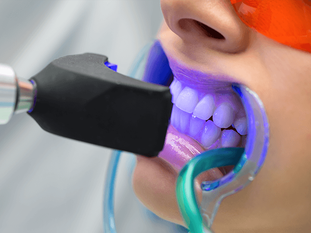 Teeth Whitening
