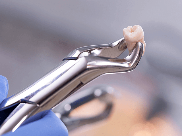 Tooth Extraction